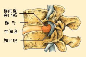 椎間盤突出示意圖